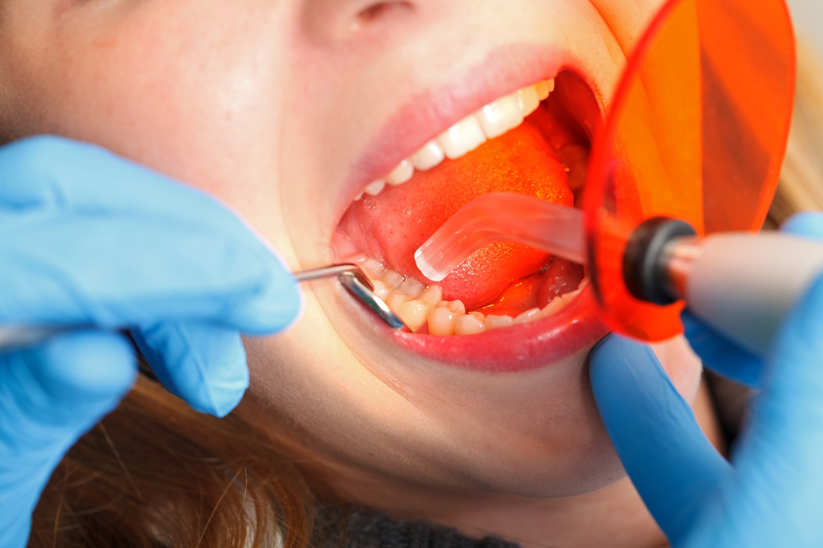 The 4 Basic Types Of Dental Fillings Voyles Family Dental